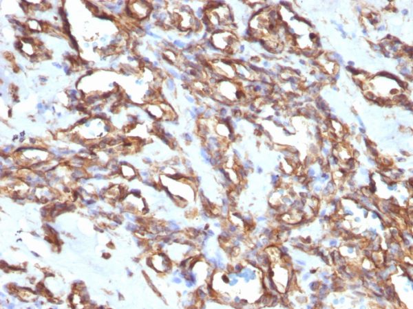 Formalin-fixed, paraffin-embedded human Angiosarcoma stained with Vimentin Mouse Monoclonal Antibody (VM1170).