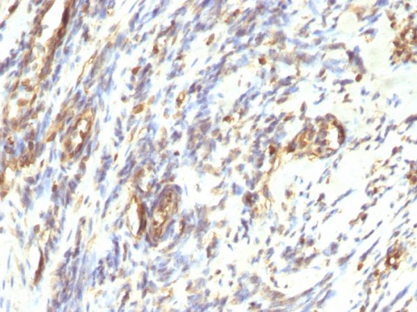 Formalin-fixed, paraffin-embedded human Leiomyosarcoma stained with Vimentin Mouse Monoclonal Antibody (VM1170).