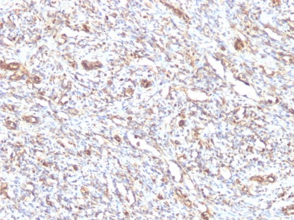 Formalin-fixed, paraffin-embedded human Rhabdomyosarcoma stained with Vimentin Mouse Monoclonal Antibody (VM1170).