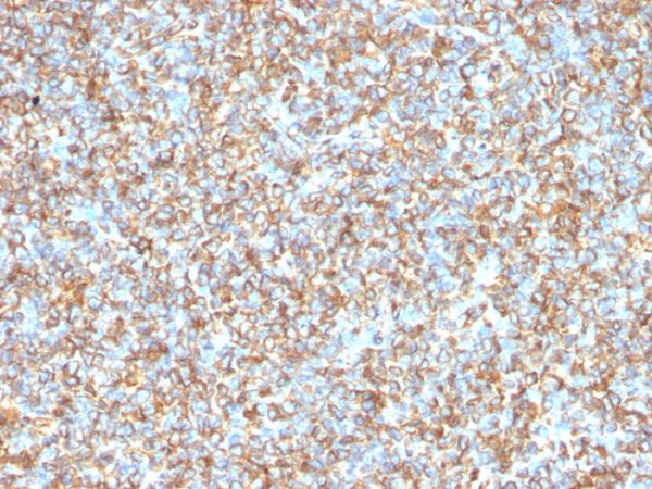 Formalin-fixed, paraffin-embedded human Ewing&apos;s Sarcoma stained with Vimentin Mouse Monoclonal Antibody (VM1170).