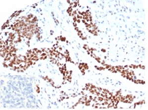 Formalin-fixed, paraffin-embedded human ovarian carcinoma stained with Wilm&apos;s Tumor Recombinant Mouse Monoclonal Antibody (rWT1/6908). Inset: PBS instead of primary antibody; secondary only negative control.