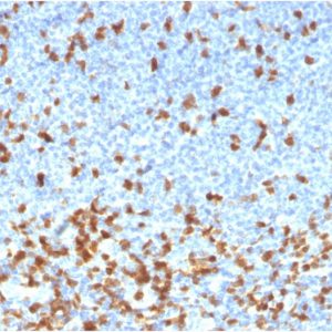 Formalin-fixed, paraffin-embedded human lymphoma stained with ZAP70 Recombinant Mouse Monoclonal Antibody (rZAP70/2046).