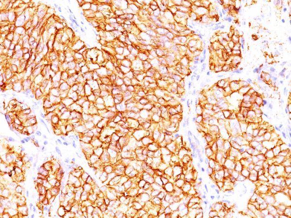 Formalin-fixed, paraffin-embedded human Renal Cell Carcinoma stained with RCC Mouse Monoclonal Antibody (66.4.C2). HIER: Tris/EDTA, pH9.0, 45min. 2°C: HRP-polymer, 30min. DAB, 5min.