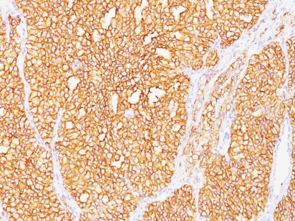 Renal Cell Carcinoma / gp200 (Carbonic Anhydrase IX) Antibody