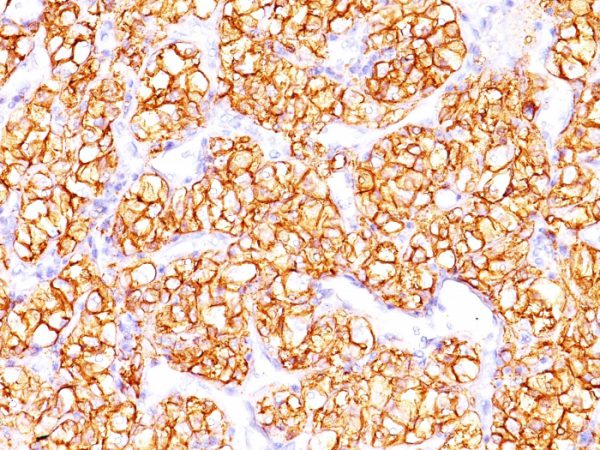 Formalin-fixed, paraffin-embedded human Renal Cell Carcinoma stained with PNA Mouse Monoclonal Antibody (PN-15).