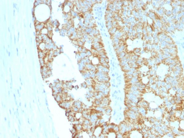 Formalin-fixed, paraffin-embedded human Colon Carcinoma stained with MAML2 Monoclonal Antibody (MAML2/1302).