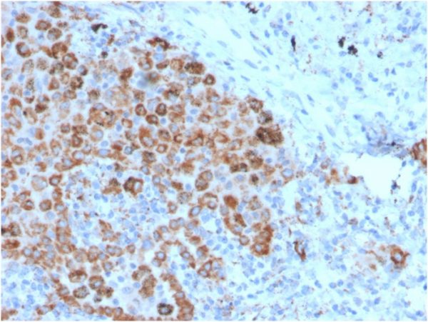 Formalin-fixed, paraffin-embeddedhuman lymph node stained with TIM3 Mouse Monoclonal Antibody (TIM3/4025).