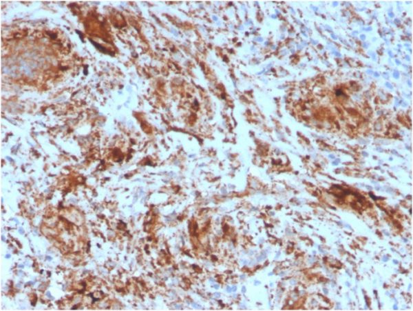 Formalin-fixed, paraffin-embeddedhuman tonsil stained with TIM3 Mouse Monoclonal Antibody (TIM3/4025).