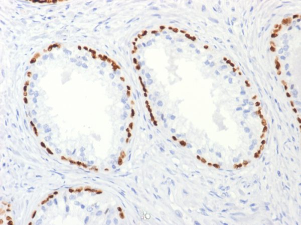 Formalin-fixed, paraffin-embedded human Prostate Carcinoma stained with p63 Mouse Monoclonal Antibody (TP63/2427).