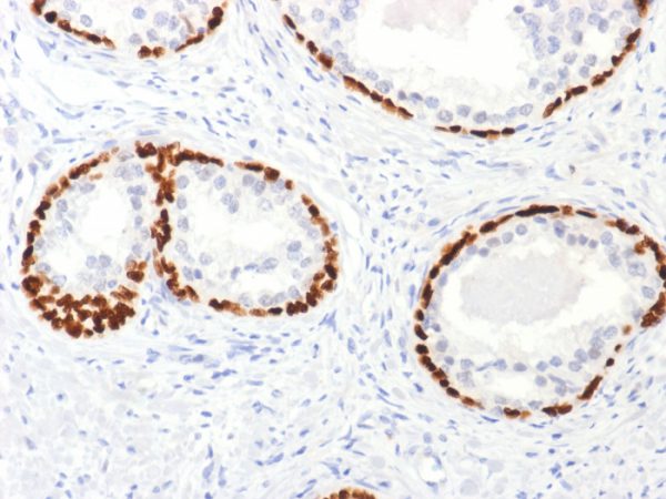 Formalin-fixed, paraffin-embedded human Prostate Cancer stained with p63 Rabbit Polyclonal Antibody.