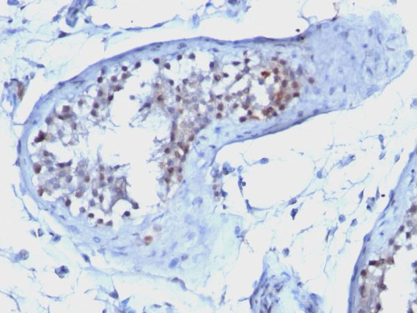 Formalin-fixed, paraffin-embedded human Testicular Carcinoma stained with Cyclin B1 Mouse Monoclonal Antibody (CCNB1/1098).