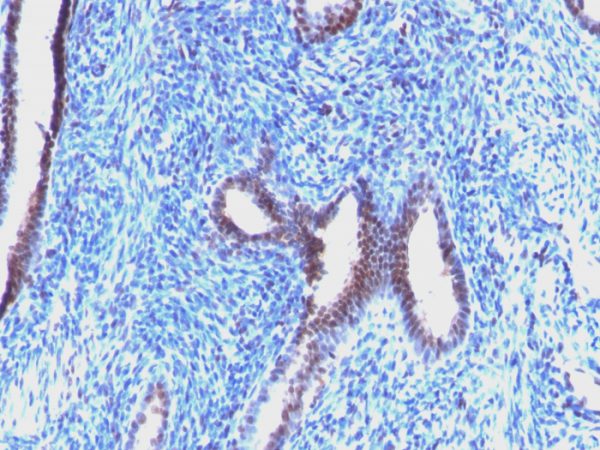 Formalin-fixed, paraffin-embedded human Endometrial Carcinoma stained with Cyclin B1 Mouse Monoclonal Antibody (CCNB1/1098).