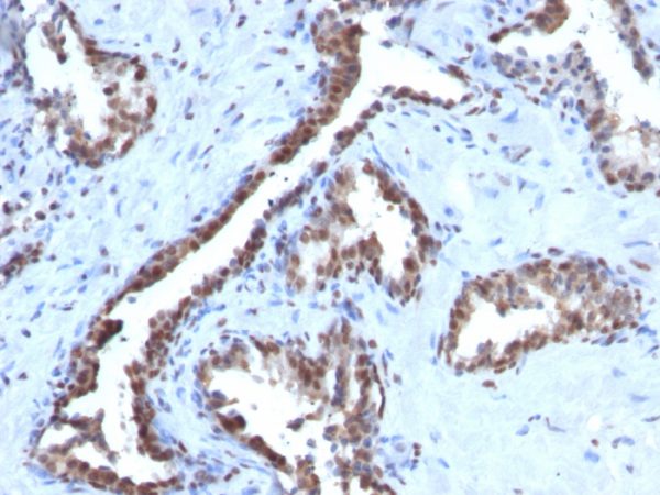 Formalin-fixed, paraffin-embedded human Prostate Carcinoma stained with Cyclin B1 Mouse Monoclonal Antibody (CCNB1/1098).