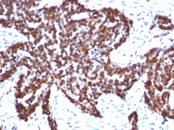 Formalin-fixed, paraffin-embedded human Ovarian Carcinoma stained with Cyclin B1 Mouse Monoclonal Antibody (CCNB1/1098).