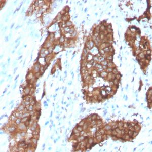 Formalin-fixed, paraffin-embedded human Breast Carcinoma stained with PDZ and LIM Domain 1 Mouse Monoclonal Antibody (PDLIM-1).