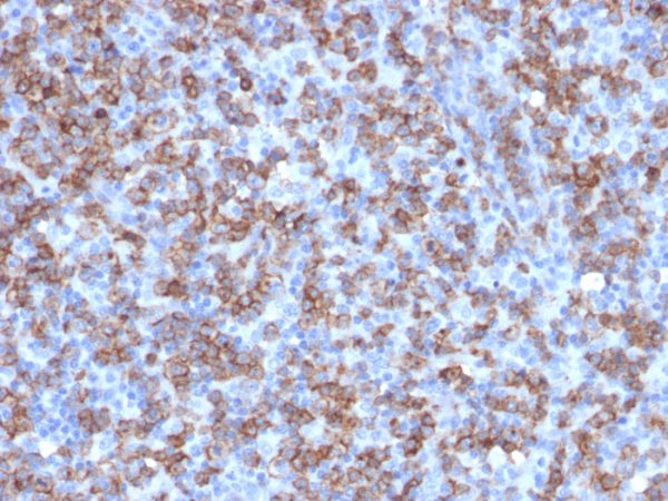 Formalin-fixed, paraffin-embedded human Lymphoma stained with CD8a Rabbit Recombinant Monoclonal Antibody (C8/1779R).
