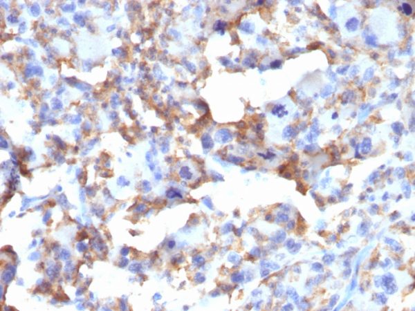 Formalin-fixed, paraffin-embedded human Histiocytoma stained with CD163 Mouse Monoclonal Antibody (M130/2163).