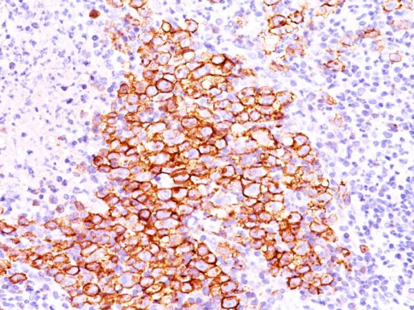 Formalin-fixed, paraffin-embedded human Hodgkin&apos;s lymphoma stained with CD30 Ab (CD30/412).