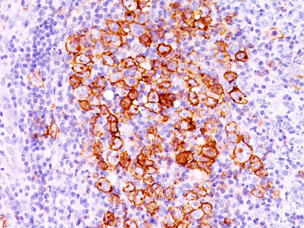 Formalin-fixed, paraffin-embedded human Hodgkin&apos;s lymphoma stained with CD30 Ab (CD30/412).