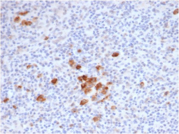 IHC analysis of formalin-fixed, paraffin-embedded human Hodgkin&apos;s lymphoma. Saining of Reed-Sternberg cells using rKi-1/6913 at 2ug/ml in PBS for 30min RT. HIER: Tris/EDTA, pH9.0, 45min. 2°C: HRP-polymer, 30min. DAB, 5min.