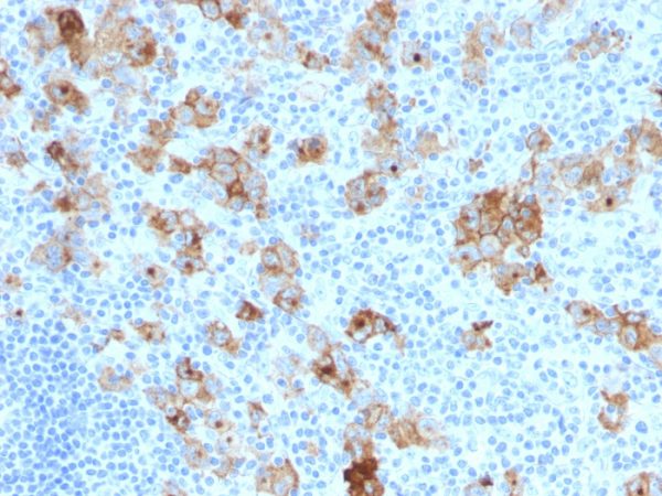 Formalin-fixed, paraffin-embedded human Hodgkin&apos;s Lymphoma stained with CD30 Monoclonal Antibody (SPM121).