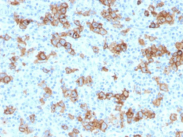 Formalin-fixed, paraffin-embedded human Hodgkin&apos;s Lymphoma stained with CD30 Monoclonal Antibody (Ki-1/779).