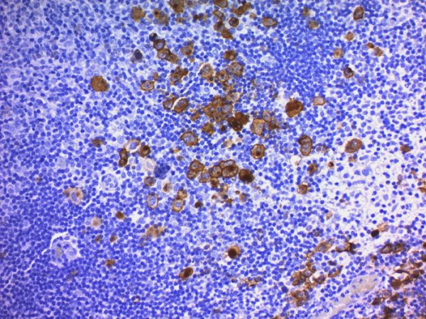 Formalin-fixed, paraffin-embedded human Hodgkin&apos;s Lymphoma stained with CD30 Monoclonal Antibody (Ber-H2 + CD30/412).