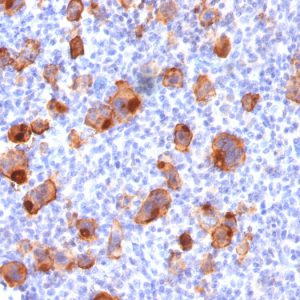 Formalin-fixed, paraffin-embedded human Hodgkin&apos;s Lymphoma stained with CD30 Mouse Recombinant Monoclonal Antibody (rKi-1/779).