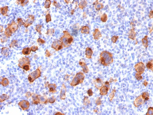 Formalin-fixed, paraffin-embedded human Hodgkin&apos;s Lymphoma stained with CD30 Mouse Recombinant Monoclonal Antibody (rKi-1/779).