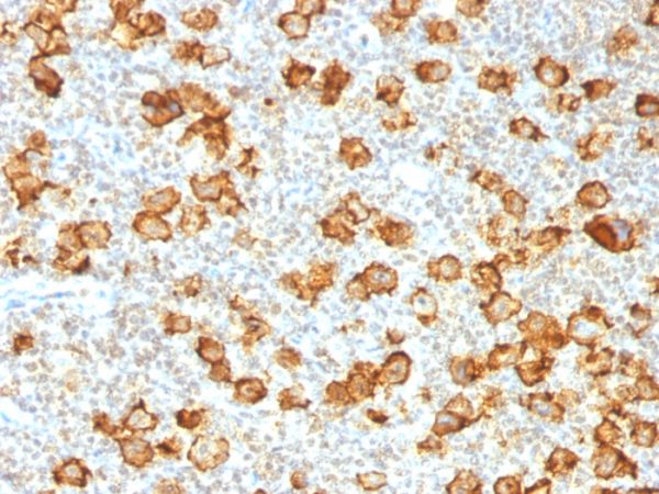 Formalin-fixed, paraffin-embedded human Hodgkin&apos;s Lymphoma stained with CD30 Rabbit Recombinant Monoclonal Antibody (Ki-1/1505R).