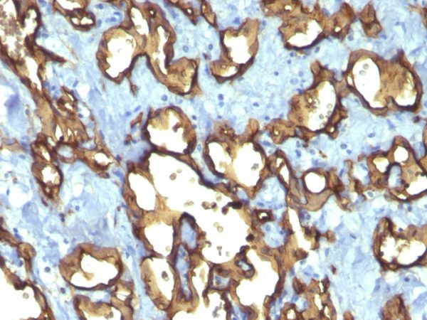 Formalin-fixed, paraffin-embedded human Angiosarcoma stained with CD34 Monoclonal Antibody (QBEnd/10 + HPCA1/763)