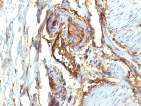 Formalin-fixed, paraffin-embedded human Colon Carcinoma stained with CD34 Monoclonal Antibody (QBEnd/10 + HPCA1/763)