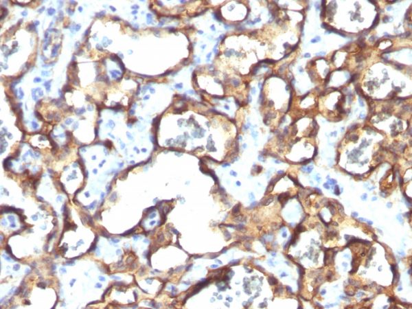 Formalin-fixed, paraffin-embedded human Angiosarcoma stained with CD34 Monoclonal Antibody (HPCA1/1171)