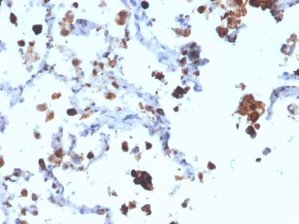 Formalin-fixed, paraffin-embedded human Lung Adenocarcinoma stained with Napsin A Mouse Monoclonal Antibody (NAPSA/3308).