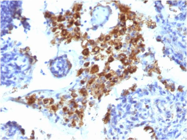 Formalin-fixed, paraffin-embedded human Lung Adenocarcinoma stained with Napsin A Mouse Monoclonal Antibody (NAPSA/1238).