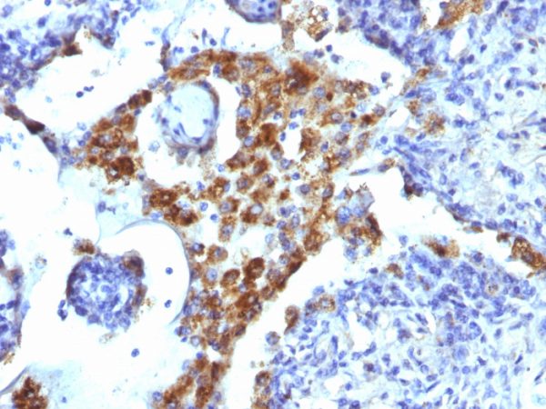 Formalin-fixed, paraffin-embedded human Lung Adenocarcinoma stained with Napsin A Mouse Monoclonal Antibody (NAPSA/1239).