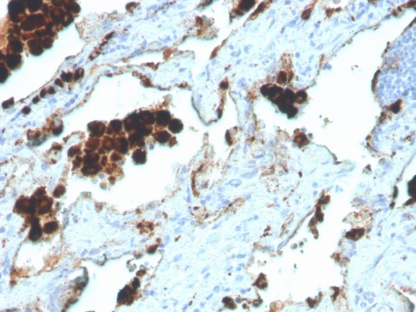 IHC analysis of formalin-fixed, paraffin-embedded human lung adenocarcinoma. NAPSA/4400R at 2ug/ml in PBS for 30min RT. HIER: Tris/EDTA, pH9.0, 45min. 2 °: HRP-polymer, 30min. DAB, 5min.
