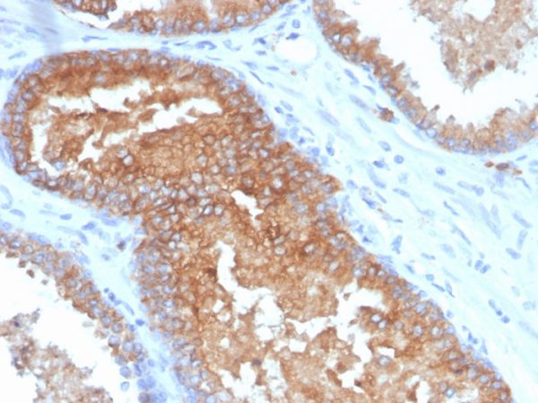 IHC analysis of formalin-fixed, paraffin-embedded human prostate carcinoma. Strong cytoplasmic and membranous staining using CD38/4328 at 2ug/ml in PBS for 30min RT. HIER: Tris/EDTA, pH9.0, 45min. 2 °: HRP-polymer, 30min. DAB, 5min.