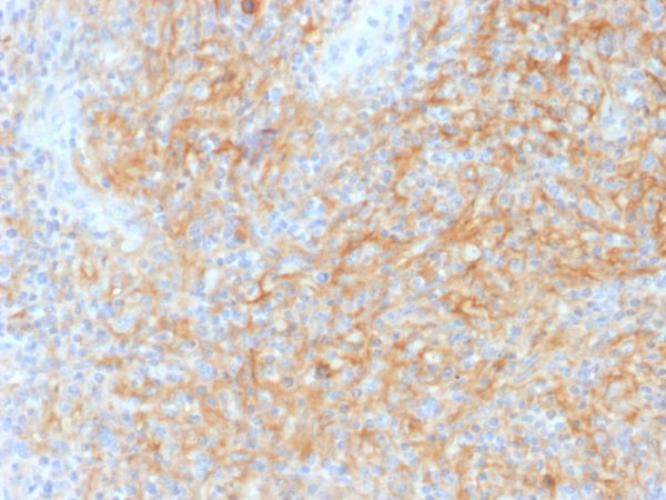 Formalin-fixed, paraffin-embedded human Hodgkin‚Äôs Lymphoma stained with CD40 Mouse Monoclonal Antibody (C40/1605).