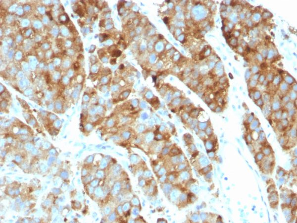 Formalin-fixed, paraffin-embedded human Prostate Carcinoma stained with CD63 Mouse Monoclonal Antibody (LAMP3/968)