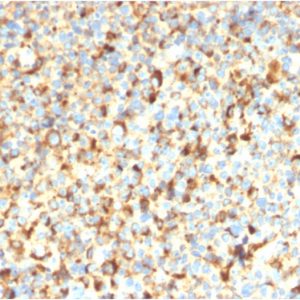 Formalin-fixed, paraffin-embedded human Melanoma stained with CD63-Monospecific Recombinant Mouse Monoclonal Antibody (rMX-49.129.5)