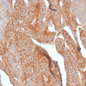 Formalin-fixed, paraffin-embedded human Prostate Carcinoma stained with CD81 Rabbit Recombinant Monoclonal Antibody (C81/2885R).