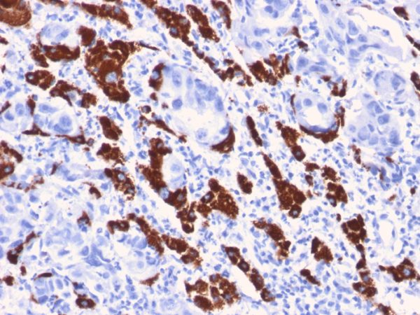 Formalin-fixed, paraffin-embedded human Liver stained with Hepatocyte Specific Antigen Mouse Monoclonal Antibody (OCH1E5).