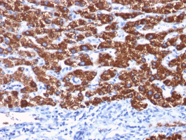 Formalin-fixed, paraffin-embedded human Hepatocellular Carcinoma stained with Hepatocyte Specific Antigen Mouse Monoclonal Antibody (OCH1E5).