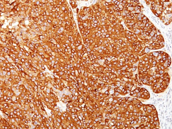 Melanoma Marker (MART-1 + Tyrosinase + gp100) Antibody