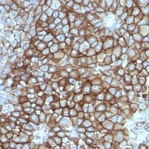 Formalin-fixed, paraffin-embedded human Melanoma stained with Melanoma Monoclonal Antibody (KBA.62).