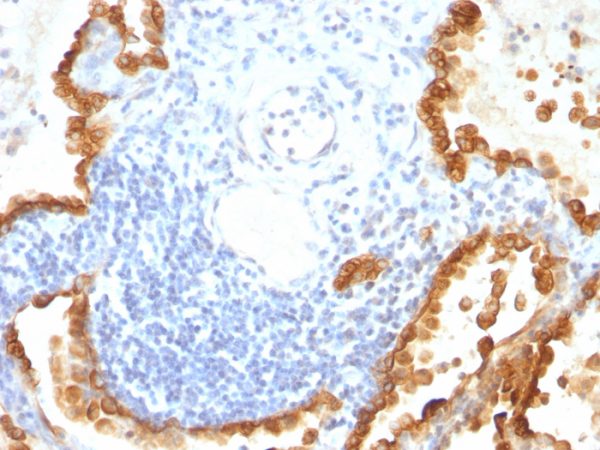 Formalin-fixed, paraffin-embedded human Lung Carcinoma stained with Cytokeratin 8/18 Monoclonal Antibody (KRT8/803 + KRT18/835).