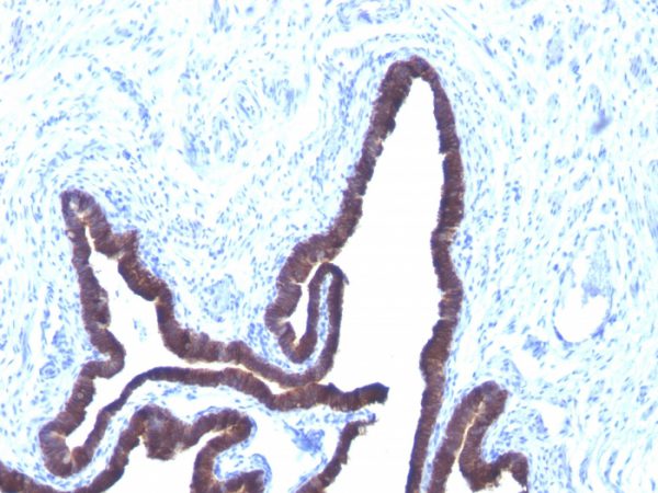 Formalin-fixed, paraffin-embedded human Ovarian Cancer stained with Cytokeratin 8/18 Monoclonal Antibody (KRT8/803 + KRT18/835).