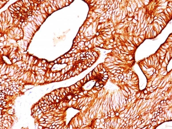 Formalin-fixed, paraffin-embedded human Colon Carcinoma stained with Cytokeratin 8/18 Monoclonal Antibody (KRT8/803 + KRT18/835).