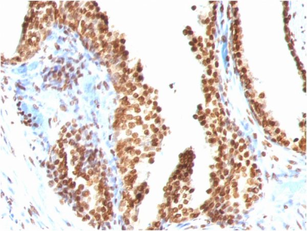 Formalin-fixed, paraffin-embedded human Colon Carcinoma stained with Double Stranded DNA Mouse Monoclonal Antibody (AE-2)